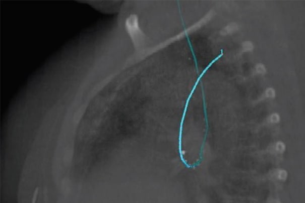 LumenCare<sup>®</sup>施源器——图片由UZL Gasthuisberg(比利时鲁汶)提供